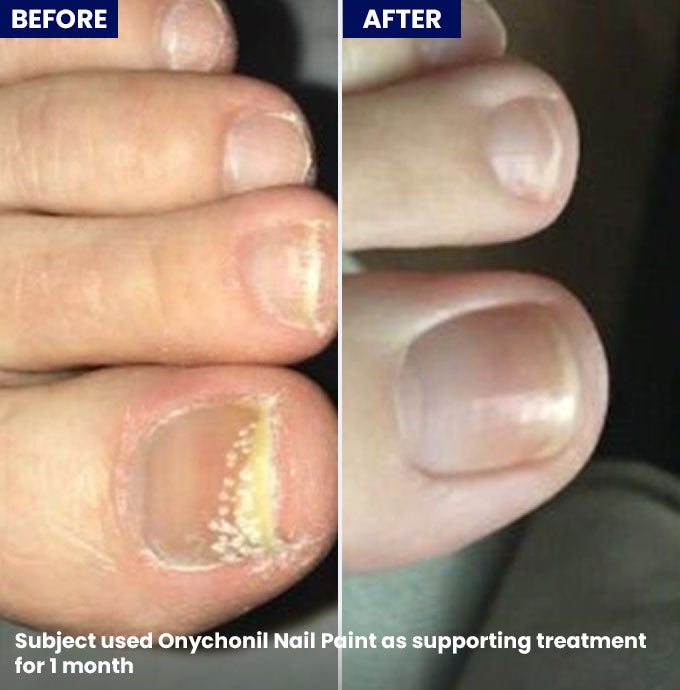 Jenpharm Onychonil Nail Paint