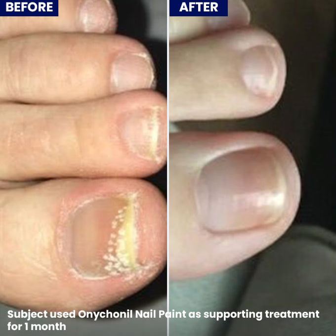 Jenpharm Onychonil Nail Paint