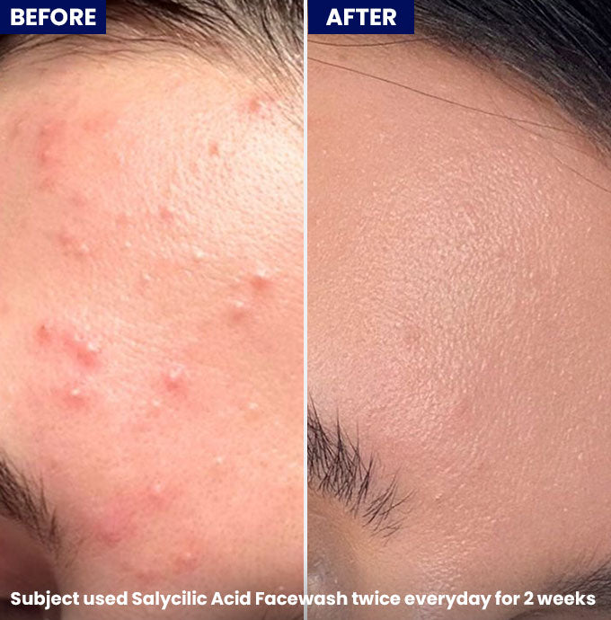 Jenpharm Clarevo Salicylic Acid Facewash