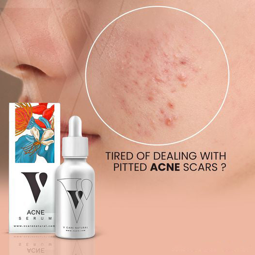 Acne Serum - Vcare Natural