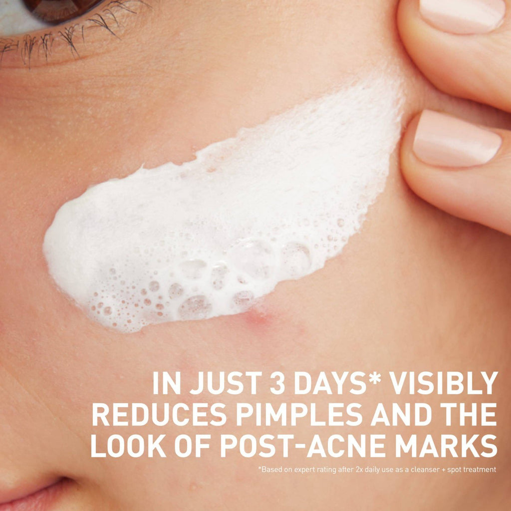 CeraVe Acne Clay-to-Foam Cleanser used as daily cleanser, weekly mask and spot treatment