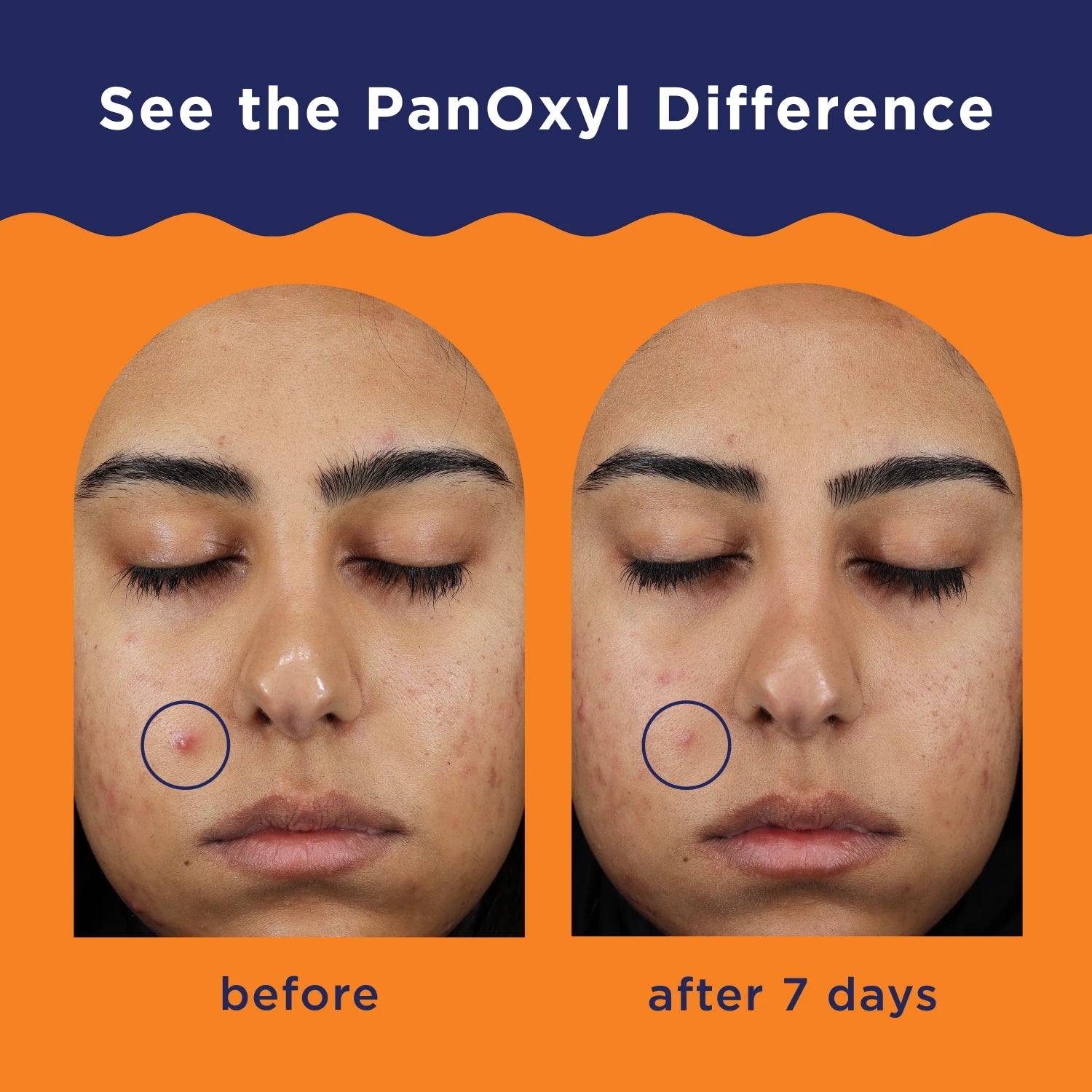 PanOxyl Acne Clearing Spot Treatment - 10% Benzyl Peroxide