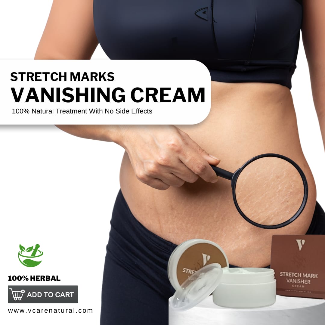 Stretch Mark Vanishing Cream Vcare Natural www.vcarenatural.com