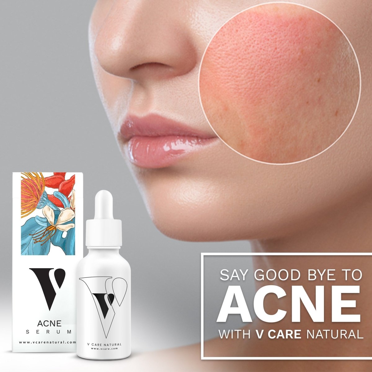 Acne Serum - Vcare Natural